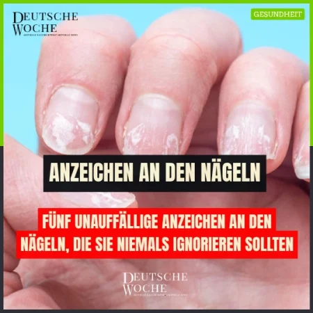 Fünf unauffällige Anzeichen an den Nägeln, die Sie niemals ignorieren sollten