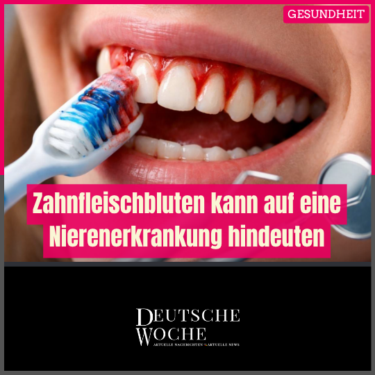 Studie: Zahnfleischbluten kann auf eine Nierenerkrankung hindeuten Studie: Zahnfleischbluten kann auf eine Nierenerkrankung hindeuten