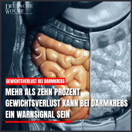 Mehr als zehn Prozent Gewichtsverlust kann bei Darmkrebs ein Warnsignal sein